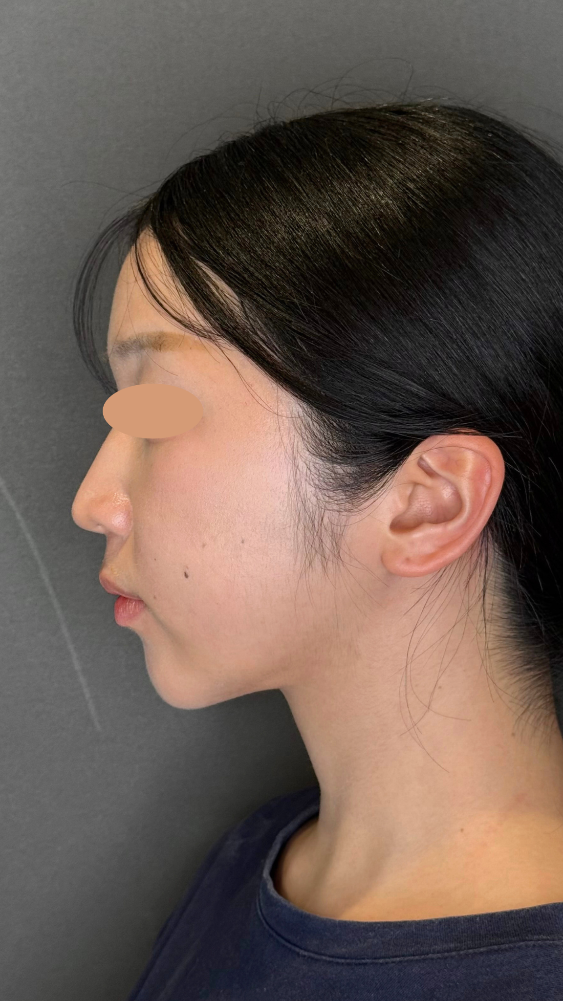 20代女性の小顔脂肪吸引（頬・顎下・ジョールファット）の症例経過。術前の状態から、術後翌日のダウンタイム（腫れや内出血）のリアルな様子、術後4ヶ月の自然で綺麗なフェイスラインが完成するまでの比較写真。
