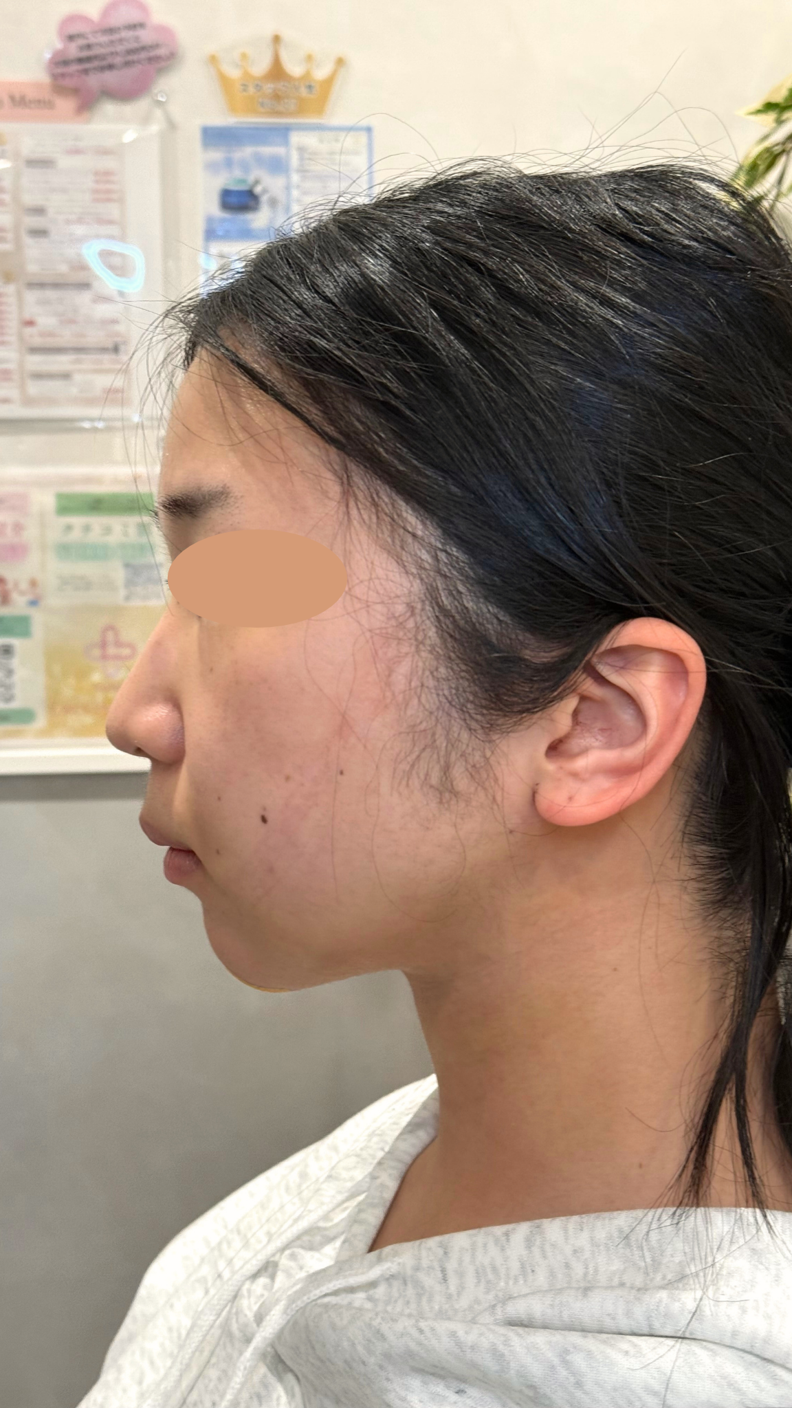 20代女性の小顔脂肪吸引（頬・顎下・ジョールファット）の症例経過。術前の状態から、術後翌日のダウンタイム（腫れや内出血）のリアルな様子、術後4ヶ月の自然で綺麗なフェイスラインが完成するまでの比較写真。